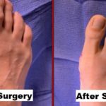How to Get Smaller Feet with Surgery