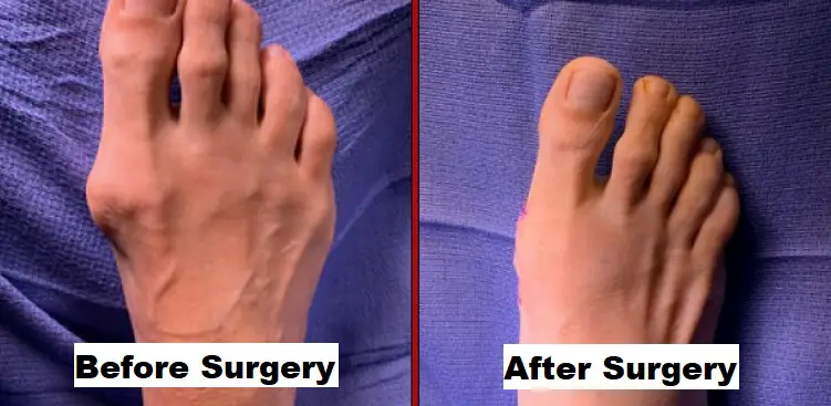 How to Get Smaller Feet with Surgery