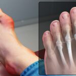 Best Shoes for Arthritis in Big Toe