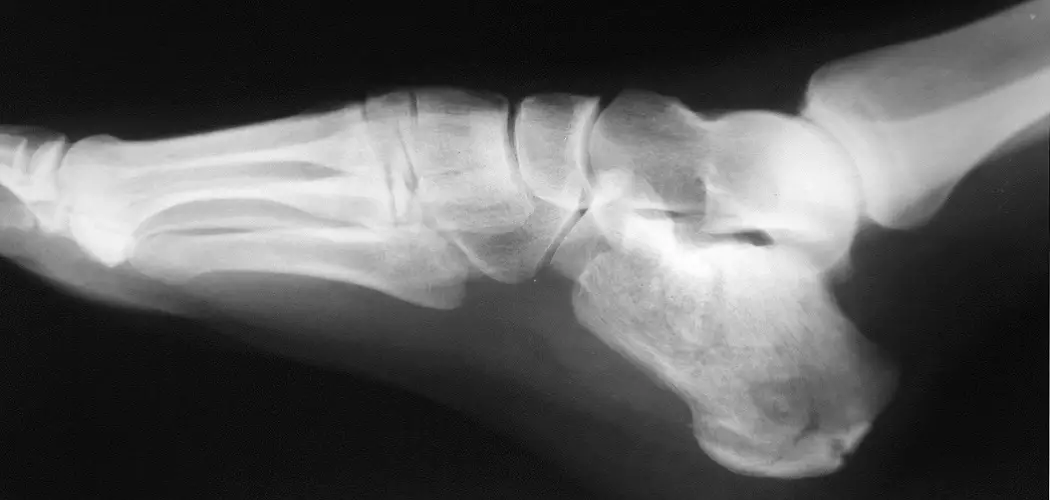 Life After a Calcaneus Fracture