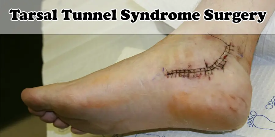 Cirugía del síndrome del túnel tarsiano