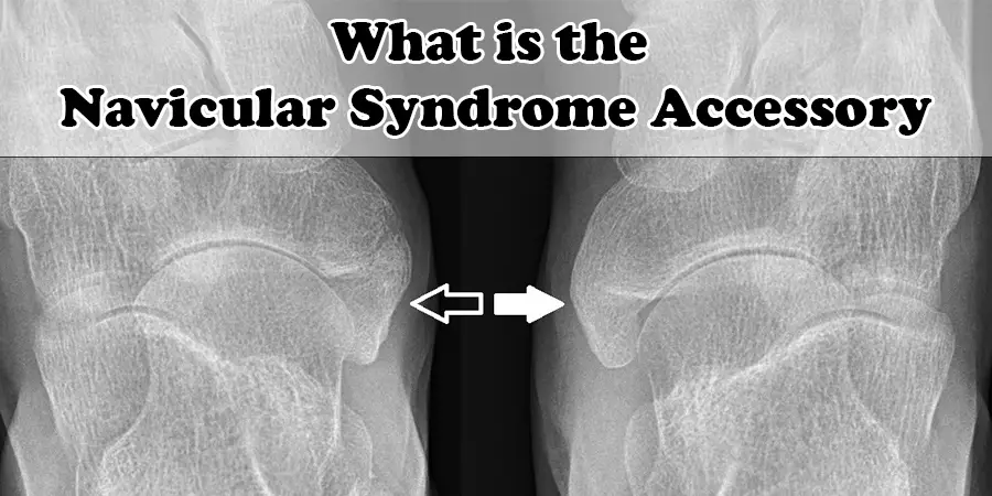 What is the Navicular Syndrome Accessory