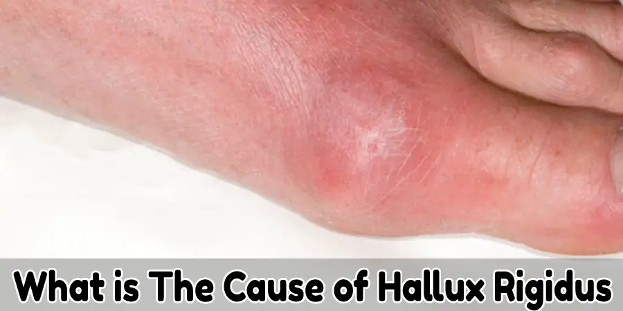 What is The Cause of Hallux Rigidus
