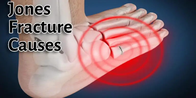 How To Heal A Jones Fracture Faster 2023 10 Effective Methods