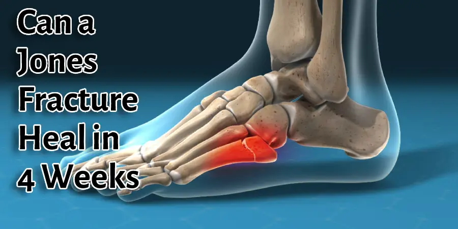 Can a Jones Fracture Heal in 4 Weeks