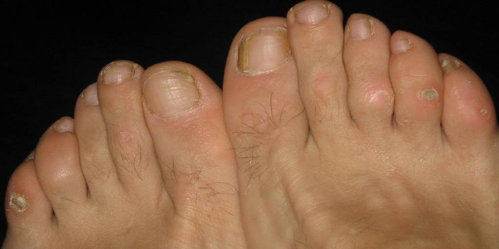 5 Best Shoes for Corns and Calluses Guides The Shoe Buddy