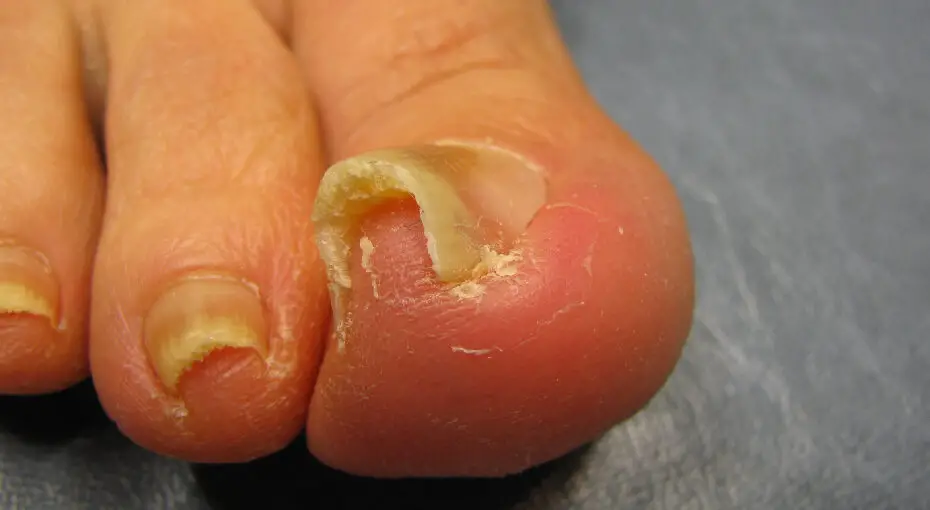 Best Socks for Ingrown Toenails