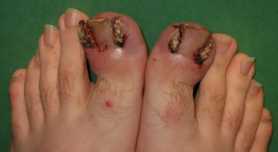 Best School Shoes for Ingrown Toenails