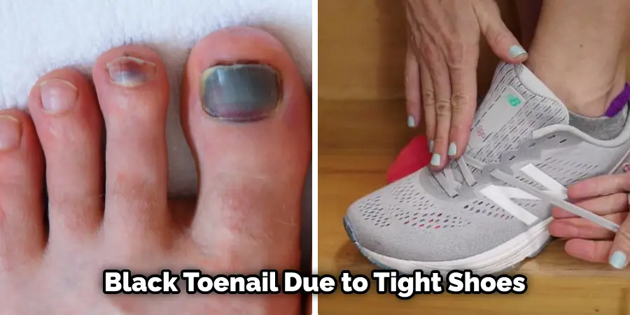 Black Toenail Due to Tight Shoes