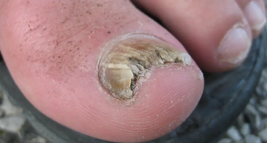 How to Wear Sandals With Toenail Fungus